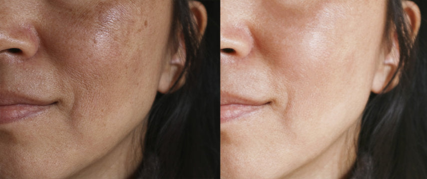 An Easy Guide to Melasma 101