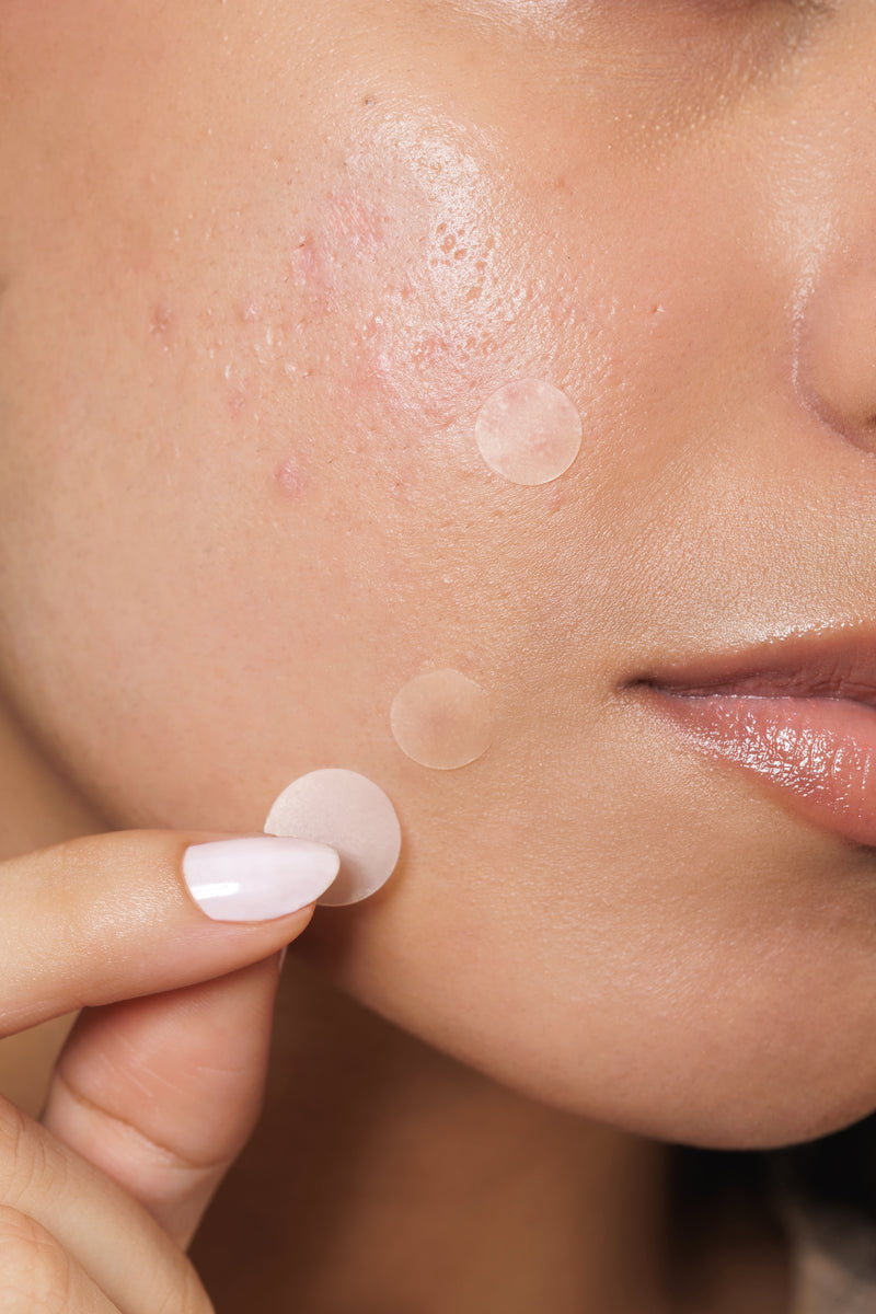 Breakouts & Acne